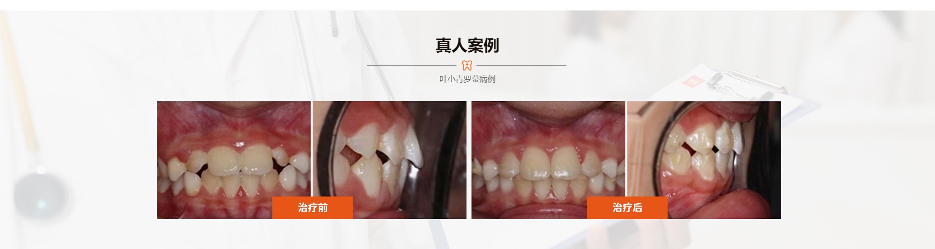 叶小青儿童牙案例